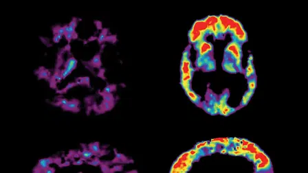 The Alzheimer's Project