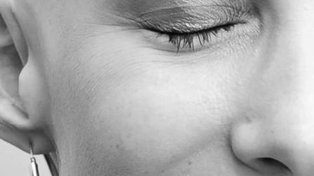 No Evidence of Disease